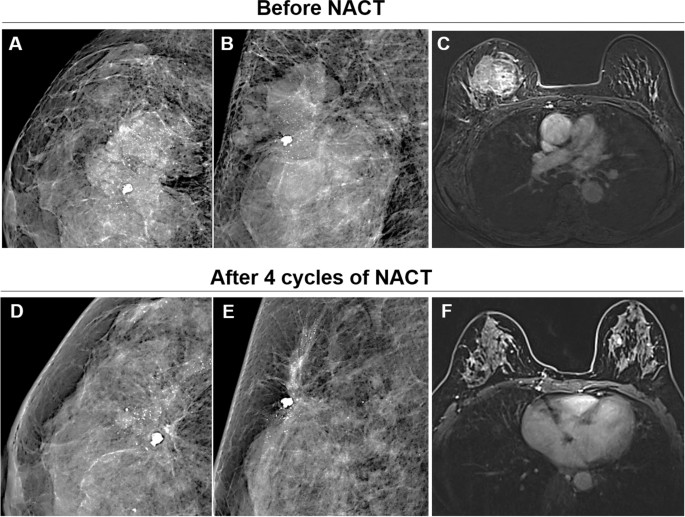 Mammographic microcalcifications and risk of breast cancer