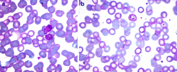 Plasmodium ovaleparasites (initially diagnosed asP. viv | Open-i