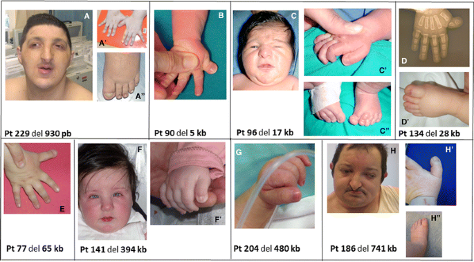 Rubinstein - Taybi syndrome: phenotypic characteristics