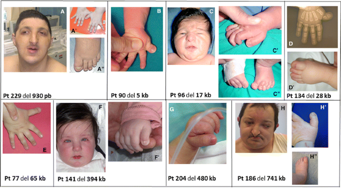 Mosaic CREBBP mutation causes overlapping clinical features of Rubinstein–Taybi  and Filippi syndromes