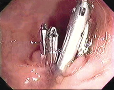 Endoscopic repair of a large colonoscopic perforation with clips | Surgical  Endoscopy