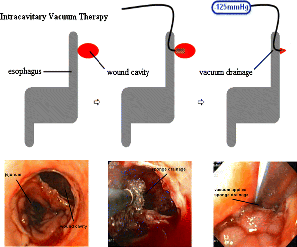 Endoscopic vacuum therapy of anastomotic leakage and iatrogenic perforation  in the esophagus