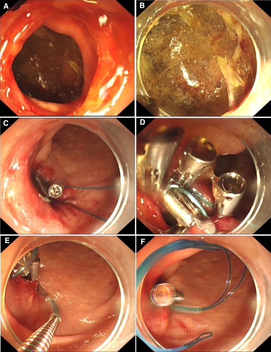 Extrahepatic Biliary System | Abdominal Key