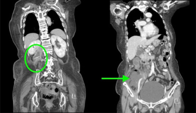 2019 Scientific Session of the Society of American Gastrointestinal and Endoscopic Surgeons (SAGES), Baltimore, Maryland, USA, 36 April 2019: 2019 Posters | Surgical Endoscopy | Springer Nature Link 2019 Scientific Session of the Society of American Gastrointestinal and Endoscopic Surgeons (SAGES), Baltimore, Maryland, USA, 36 April 2019: 2019 Posters | Surgical Endoscopy | Springer Nature Link