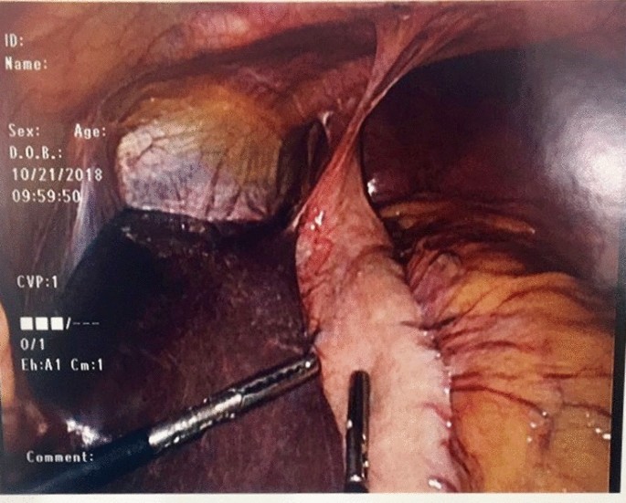 2020 Virtual Scientific Session of the Society of American Gastrointestinal and Endoscopic Surgeons (SAGES), 1113 August 2020 | Surgical Endoscopy | Springer Nature Link 2020 Virtual Scientific Session of the Society of American Gastrointestinal and Endoscopic Surgeons (SAGES), 1113 August 2020 | Surgical Endoscopy | Springer Nature Link