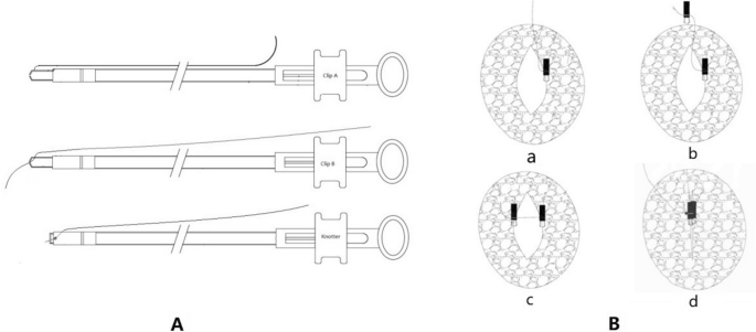 Endoscopic clip closure techniques used in the present study. a