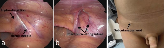 Scarless Umbilicoplasty Technique | Plastic Surgery Key