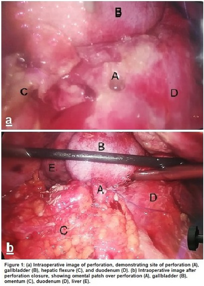 closest glp-1 gastric intestinal obstruction lawsuit in louisiana 2021 Scientific Session of the Society of American Gastrointestinal and Endoscopic Surgeons (SAGES), Las Vegas, Nevada, 31 August–3 September 2021: Posters | Surgical Endoscopy