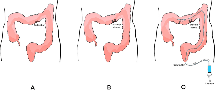 Endoclip combined with colonic transendoscopic enteral tubing: a