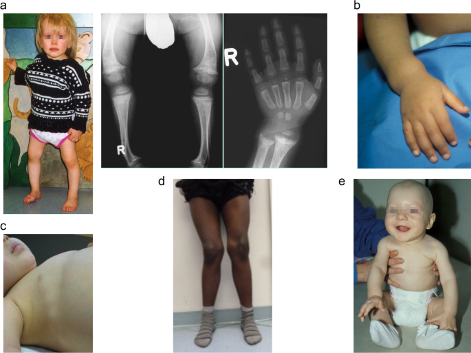 Rickets guidance: part I—diagnostic workup | Pediatric Nephrology
