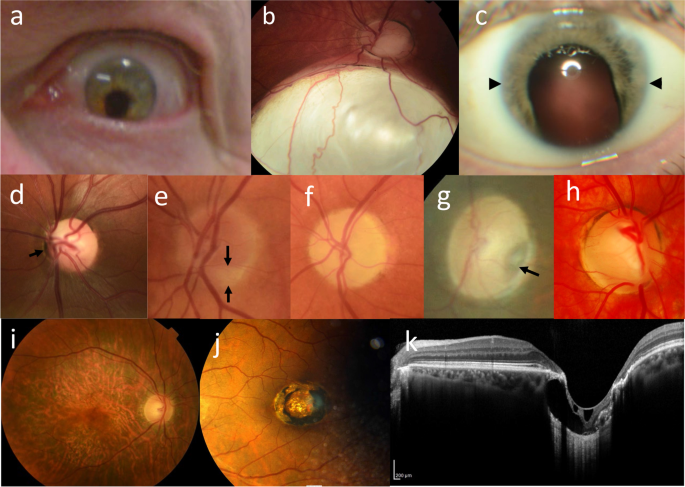 Ocular features in Rubinstein-Taybi syndrome: investigation of 24
