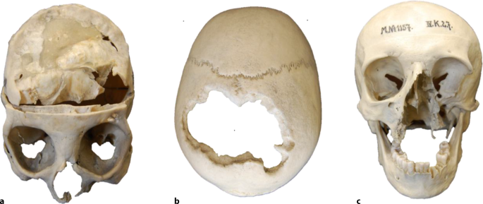 Prognathous, callipygous, steatopygous, exophthalmos