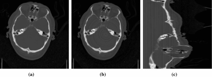 Common artifacts in CT images. (a) Streak artifact, (b) Ring artifact,... |  Download Scientific Diagram