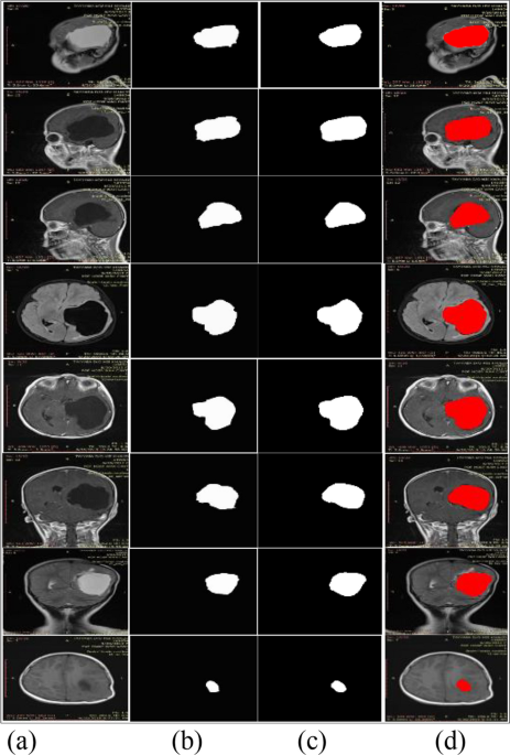 Detection of brain space-occupying lesions using quantum machine