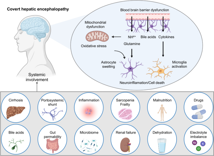Covert hepatic encephalopathy as a multi-organ syndrome: the gut–liver–muscle–brain  axis, diagnosis, treatment, and multidisciplinary care | Journal of  Gastroenterology