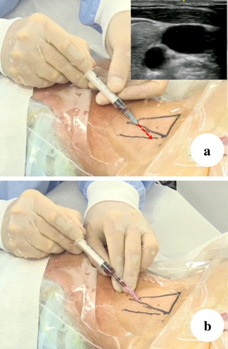 Photograph of the groin-the arrow indicating the position of the left