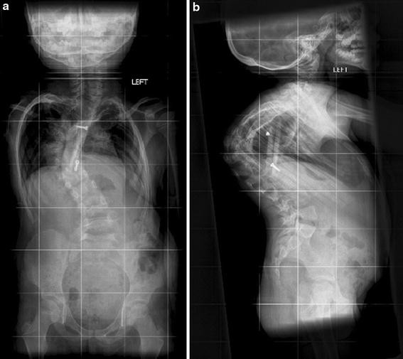 Rubinstein-Taybi syndrome with scoliosis treated with single-stage