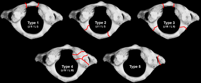 Epidemiology and management of atlas fractures | European Spine Journal