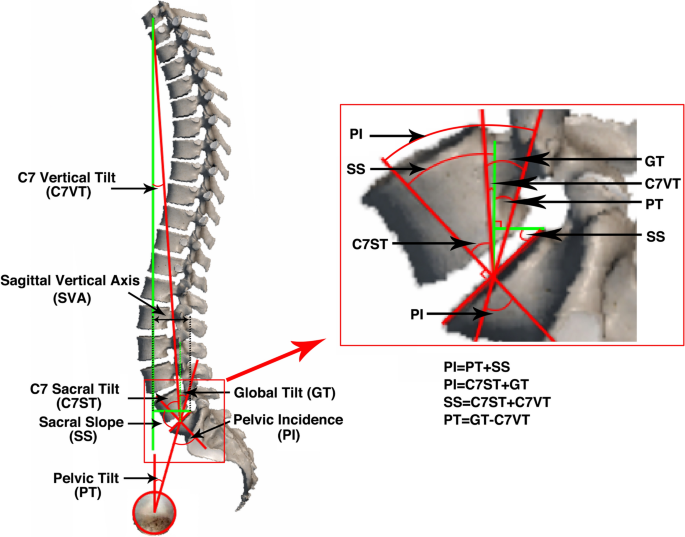 C7 sacral tilt (C7ST): a novel spinopelvic parameter reveals the  relationship between pelvic parameters and global spinal sagittal balance  and converts pelvic parameters into spinal parameters