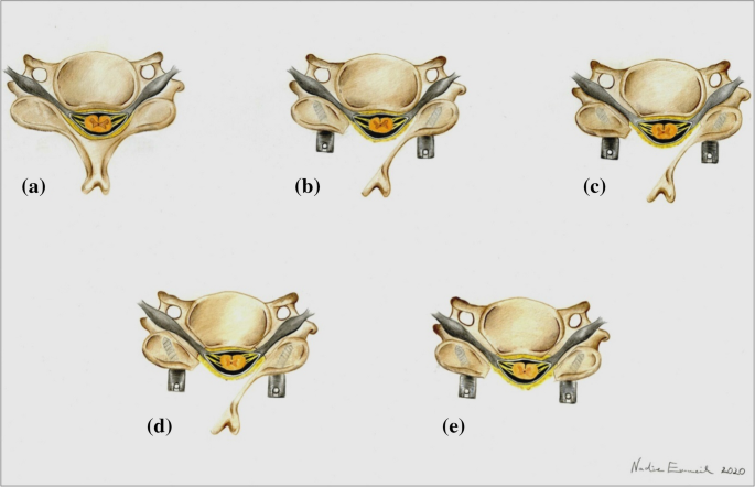 Correlation between different instrumentation variants and the degree of  destabilization in treating cervical spondylotic spinal canal stenosis by  unilateral hemilaminectomy with bilateral decompression: a biomechanical  investigation | European Spine ...