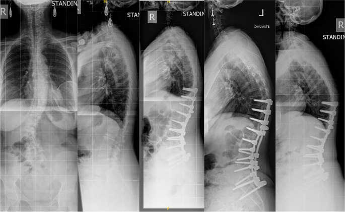 70-year-old patient. PI = 41°, so ideal Roussouly-type is 1. Ideal