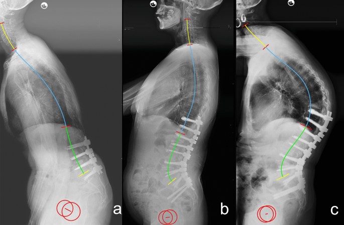 Predicting thoracic kyphosis morphology and the thoracolumbar inflection  point determined by individual lumbar lordosis in asymptomatic adults