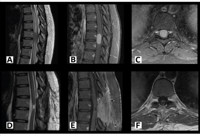 melanotic schwannoma spine Intramedullary melanocytoma: a systematic review | European Spine Journal