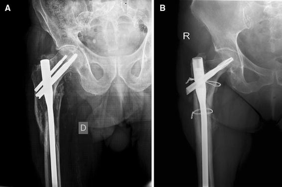 Surgical Management of Proximal Femoral Fractures by Proximal Femoral  Nailing-An Institutional Experience|crimson publishers.com