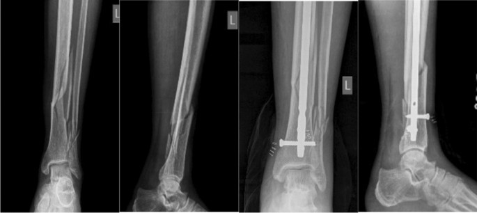 A Closer Look At Tibiotalocalcaneal Arthrodesis With Intramedullary Nailing  For Charcot Neuroarthropathy