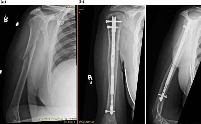 Figure 1 from Operative treatment of humeral shaft fractures. Comparison of  plating and intramedullary nailing. | Semantic Scholar