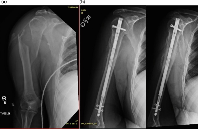 Blocking screw augmentation in intramedullary nailing for displaced  surgical neck fractures of the proximal humerus