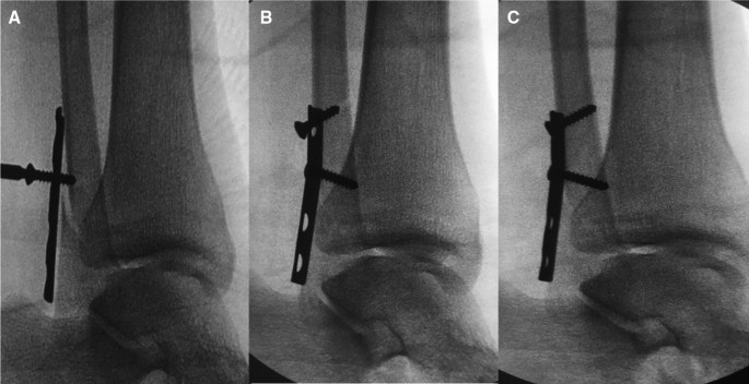 A short single-incision approach for antiglide plate fixation of oblique  fractures of the lateral malleolus: a technical tip | European Journal of  Orthopaedic Surgery & Traumatology