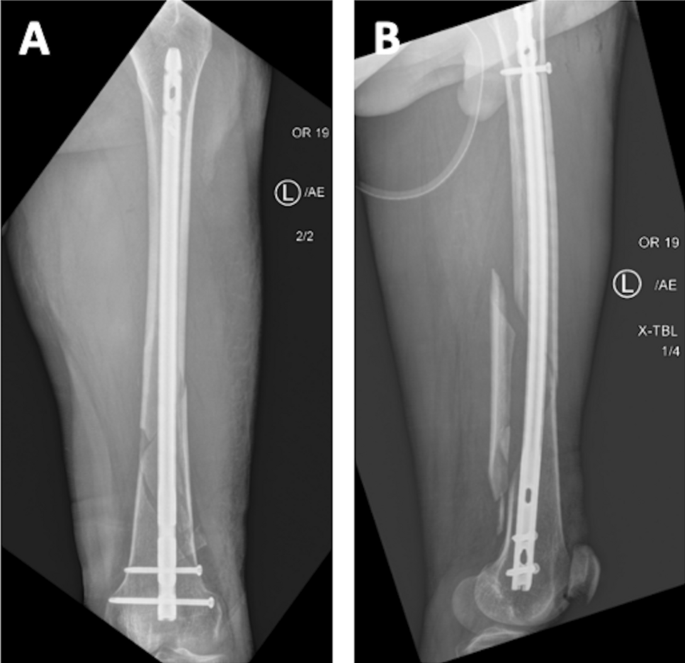 Treatment of periprosthetic supracondylar fractures after CR total knee  arthroplasty with retrograde intramedullary nailing in an elderly  population: a long term evaluation | Published in Orthopedic Reviews