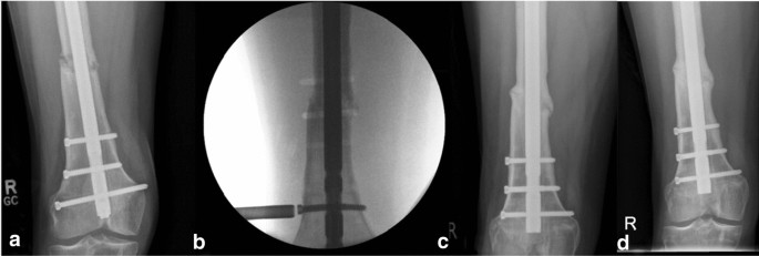 Effectiveness of exchange nailing and augmentation plating for femoral  shaft nonunion after nailing | International Orthopaedics