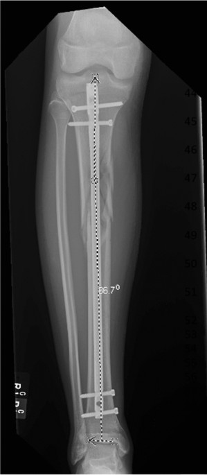 Preoperative Evaluation of Intramedullary Tibial Nail Measurements—A Review  of the Literature and a New Technique Using Contralateral Radiographs and  Digital Planning | Semantic Scholar