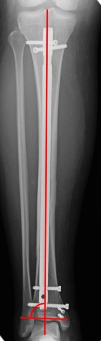 a External fixation of a Type IIIA open tibial fracture | Open-i