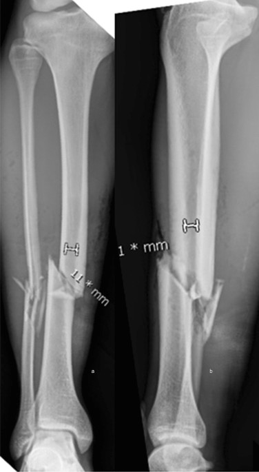 An Approach to Intraoperatively Identify the Coronal Plane Deformities of  the Distal Tibia When Treating Tibial Fractures with Intramedullary Nail  Fixation: a Retrospective Study - Lu - 2022 - Orthopaedic Surgery - Wiley  Online Library