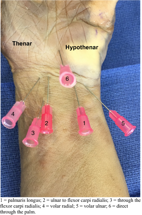 where to inject bpc 157 for carpal tunnel syndrome can cause numbness, tingling, weakness, and pain in the hands and wrists, making everyday tasks difficult. The good news? Occupational therapy can help relieve symptoms, improve hand function, and Intra-Articular Injection Of Peptides For