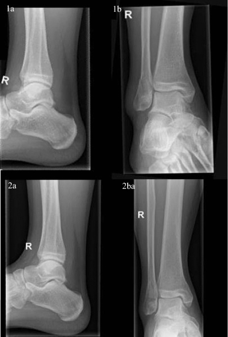 Prospective randomized controlled trial: early weight bearing after  conservative treatment of Weber B ankle fractures (pancake trial)