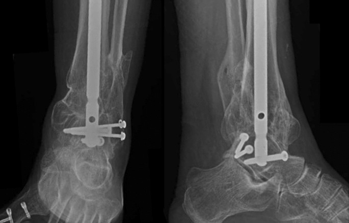 Catastrophic Hindfoot Collapse after Tibiotalocalcaneal Nailing: A Case  Series