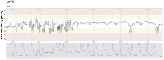 Le CTG (cardiotocographe) - LetsFamily