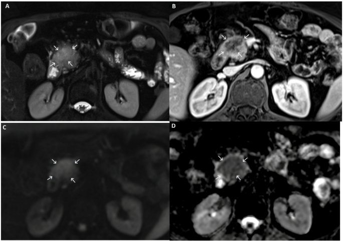 semaglutide and pancreatic cancer Glycaemic changes during early treatment: a case of adenocarcinoma | Acta Diabetologica Mood Semaglutide 5mg — Selective Méret:60 kapszula
