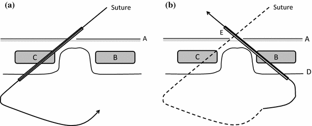 Two-step technique for fascial closure.