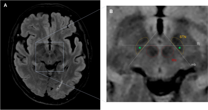 How I do it — asleep DBS placement for Parkinson’s disease