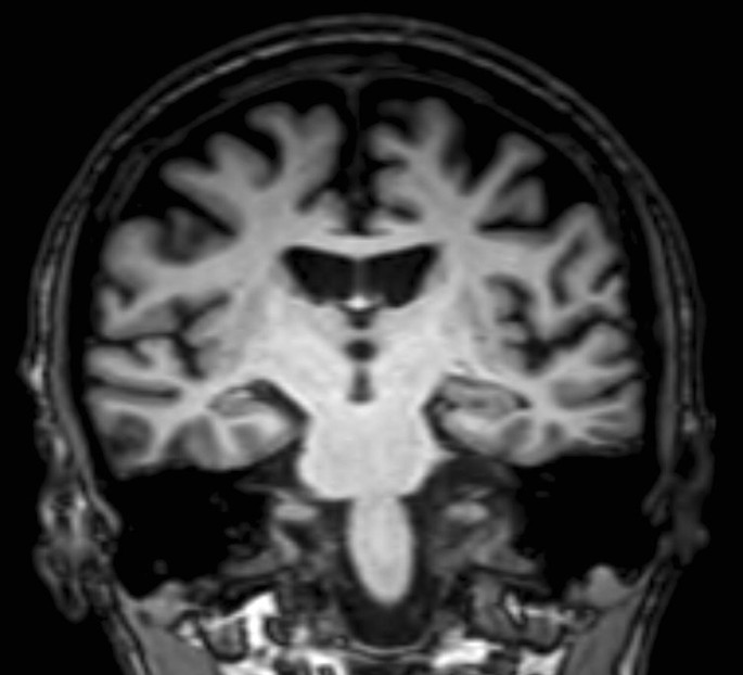 Doença de Niemann-Pick tipo C: apraxia do olhar e ataxia recessiva