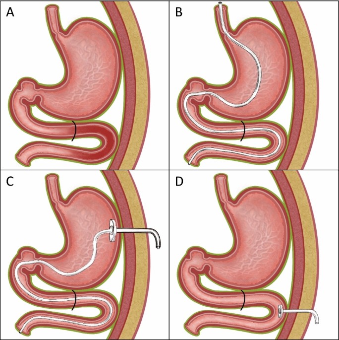Optimised endoscopic access for intrajejunal levodopa application in idiopathic Parkinson's syndrome
