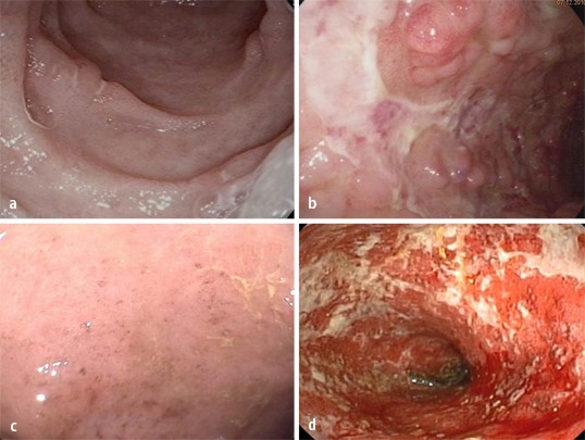 Morbus Crohn und Colitis ulcerosa | Wiener klinisches Magazin | Springer  Nature Link