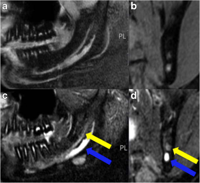 Marginal mandibular nerve, Radiology Reference Article