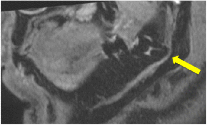 Inferior alveolar nerve, Radiology Reference Article