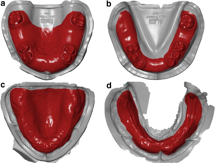 Can you use an intraoral scanner for upper jaw impressions